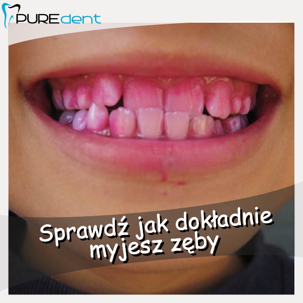 tabletka-do-wybarwiania-osadu-na-z-bach-puredent-stomatologia